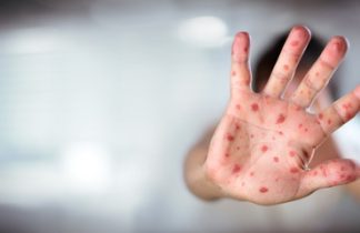 measles