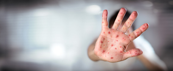 measles